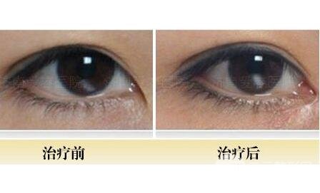 开眼角的果自然吗?