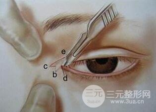 微创开内眼角会留疤吗?