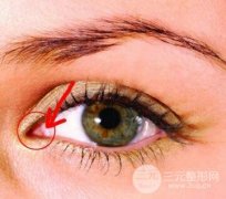 开眼角术后护理注意哪些？
