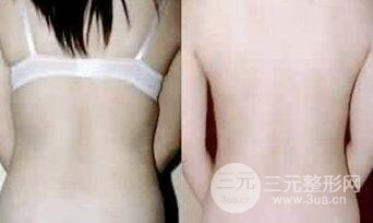 背部抽脂成好吗?降低风险吗?多少钱? 后背吸脂果图 背部抽脂成好吗?降低风险吗?多少钱? 后背吸脂果图