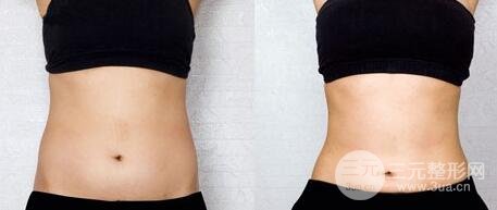 腰腹部吸脂会影响怀孕吗?