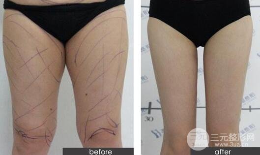 大腿吸脂有年龄限制吗?大腿吸脂前后对比图