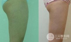 大腿吸脂后会凹凸不平吗?