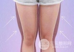 大腿吸脂术后恢复需要多长时间？