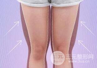 大腿吸脂术后恢复需要多长时间?