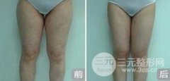 大腿吸脂会有疤痕吗？