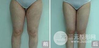 大腿吸脂会有疤痕吗?