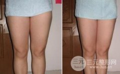 腿部吸脂会有后遗症吗?