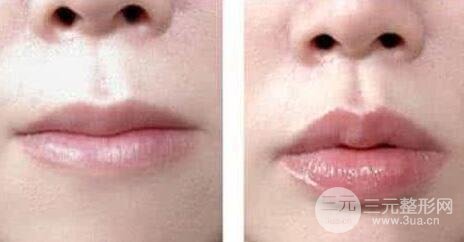 玻尿酸丰唇果自然吗?