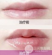 自体脂肪丰唇会过敏吗? 自体脂肪丰唇会过敏吗?
