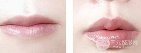 注射丰唇 让你拥有性感可爱嘟嘟唇