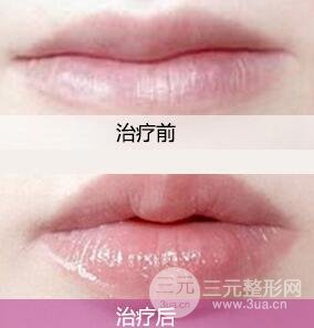 自体脂肪丰唇多久恢复？