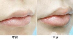 注射丰唇后有副作用吗? 注射丰唇后有副作用吗?