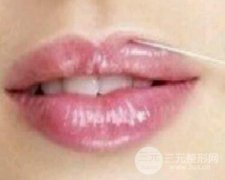 自体脂肪丰唇果自然吗? 自体脂肪丰唇果自然吗?