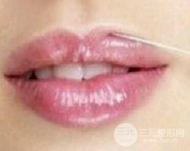 自体脂肪丰唇果自然吗?