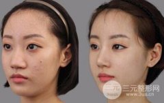 假体隆鼻后鼻子透光吗?