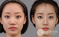 哪些人适合做自体脂肪隆鼻? 哪些人适合做自体脂肪隆鼻?