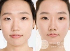 自体脂肪隆鼻后会发生移位吗? 自体脂肪隆鼻后会发生移位吗?