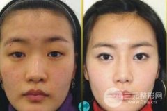自体脂肪隆鼻的果如何?能维持多久? 自体脂肪隆鼻的果如何?能维持多久?