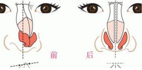 鼻子歪了如何修复?