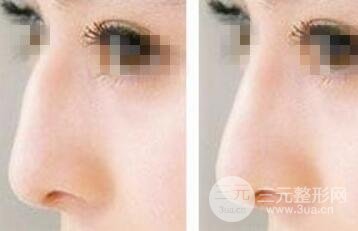 驼峰鼻矫正费用 驼峰鼻果图 会留疤吗？