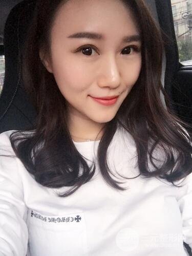 双眼皮修复术案例图 前后果对比--青岛诺德