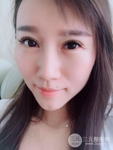 双眼皮修复术案例图 前后果对比--青岛诺德