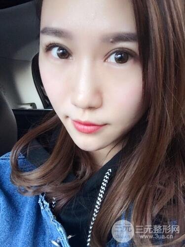 双眼皮修复术案例图 前后果对比--青岛诺德