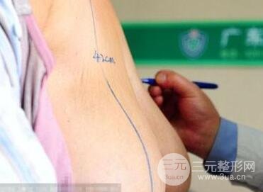 缩胸手术现在成熟吗?缩胸手术大概多少钱?