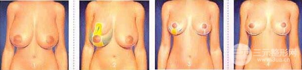 巨大乳房缩小多少钱?巨大乳房缩小术会影响哺乳吗?