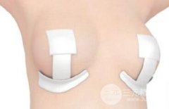 巨乳症缩小术需要尽早做吗