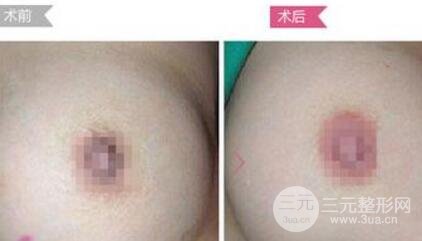 乳晕漂红降低风险吗?乳晕漂红有果吗?