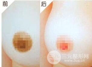 乳晕漂红术后会浮肿吗?