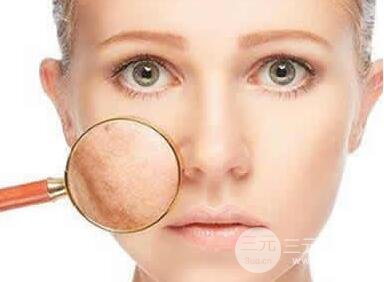 激光祛斑后会出现返黑是怎么回事?