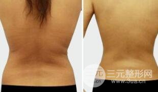 腰腹吸脂是怎么做的?腰腹吸脂后能立即洗澡吗?