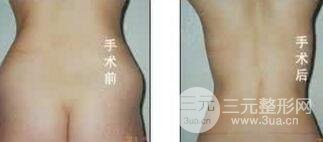 腹部吸脂有副作用?
