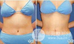 腹部吸脂手术有后遗症吗?