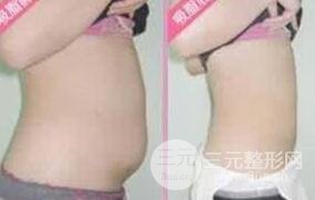 腹部吸脂后穿多久塑身衣?