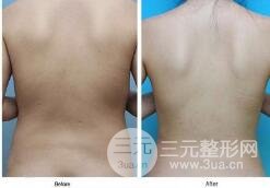 腹部吸脂凹陷应该怎么办?