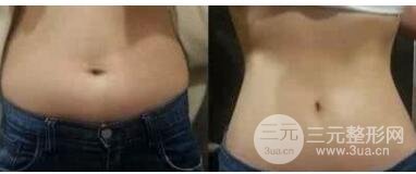 腹部吸脂有副作用吗？