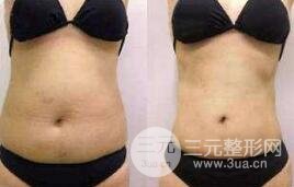 做腰腹部吸脂后可能会出现哪些不良反应？