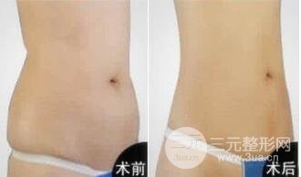 腰腹部吸脂是怎么做的？腰腹部吸脂后肌肤会松弛吗?