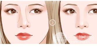 鼻子歪了怎么办?歪鼻矫正之后多久恢复? 鼻子歪了怎么办?歪鼻矫正之后多久恢复?