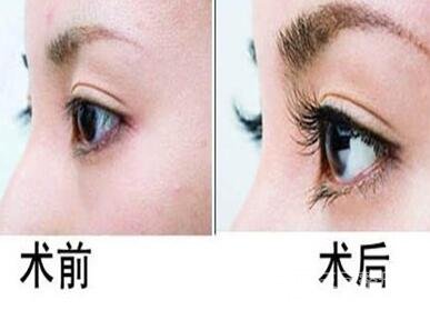 睫毛种植的成好吗？