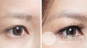 睫毛种植有副作用吗？