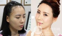 发际线种植后容易脱落吗? 发际线种植后容易脱落吗?
