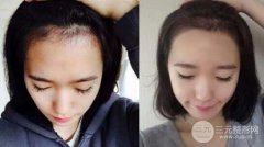 发际线种植是否容易脱落吗? 发际线种植是否容易脱落吗?