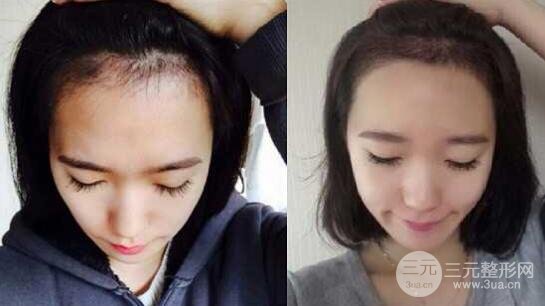 发际线种植是否容易脱落吗?