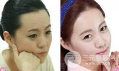 如何修饰出好看的发际线?发际线脱毛要注意哪些事项? 如何修饰出好看的发际线?发际线脱毛要注意哪些事项?