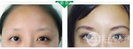 眉毛种植术的成好吗?